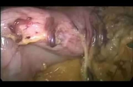 Onur Peşluk Video -2-Laparoskopik mide kelepçesi çıkarılması ve tüp mide ameliyatı