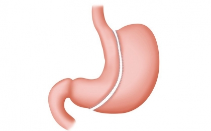 Sleeve Gastrectomy