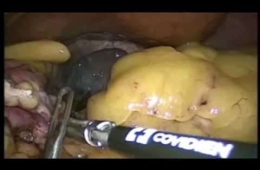 Onur Peşluk Video 1- Sleeve gastrektomi tüp mide ameliyatı